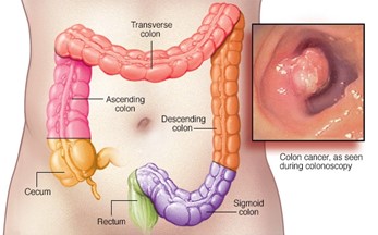 Colon Diagram and Colon Cancer as seen during a colonoscopy