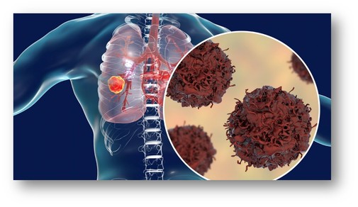 Lung Cancer Graphic