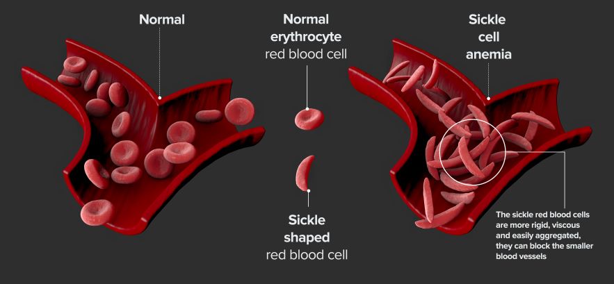 Drawing of how sickled red blood cells look different to normal red blood cells