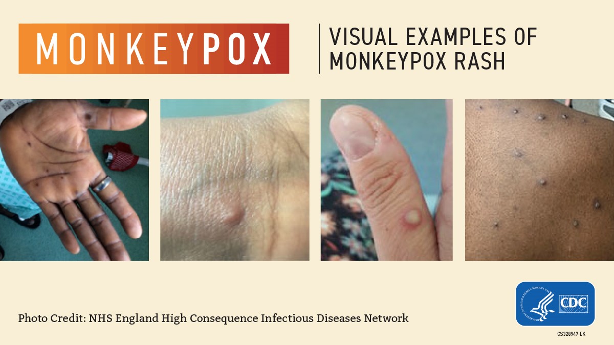 Visuals CDC Monkeypox 
